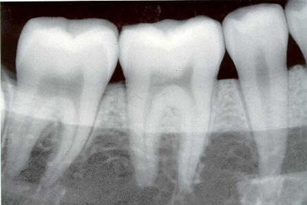 Dental X Ray 2