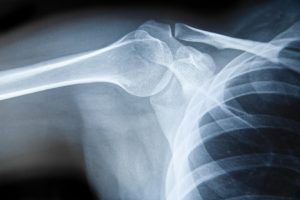 X-Ray Waste