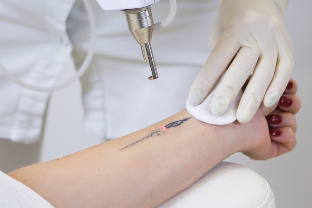Close Up,Of,Laser,Tattoo,Removal,From,Woman,Hand